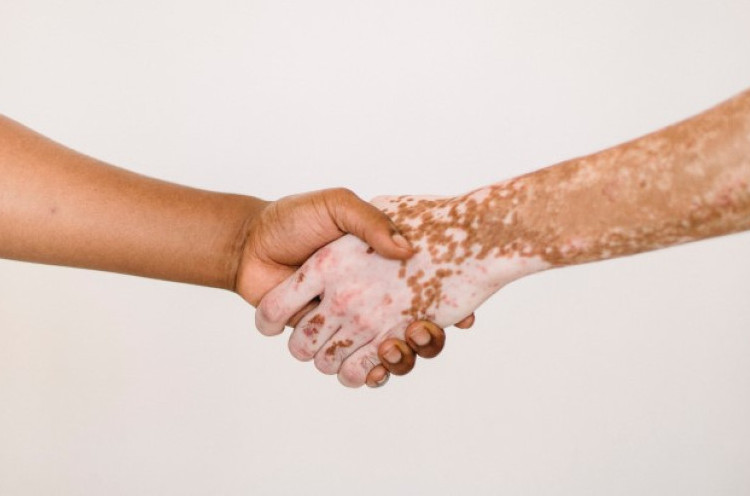 Vitiligo, Ketika Kulit Kehilangan Warna