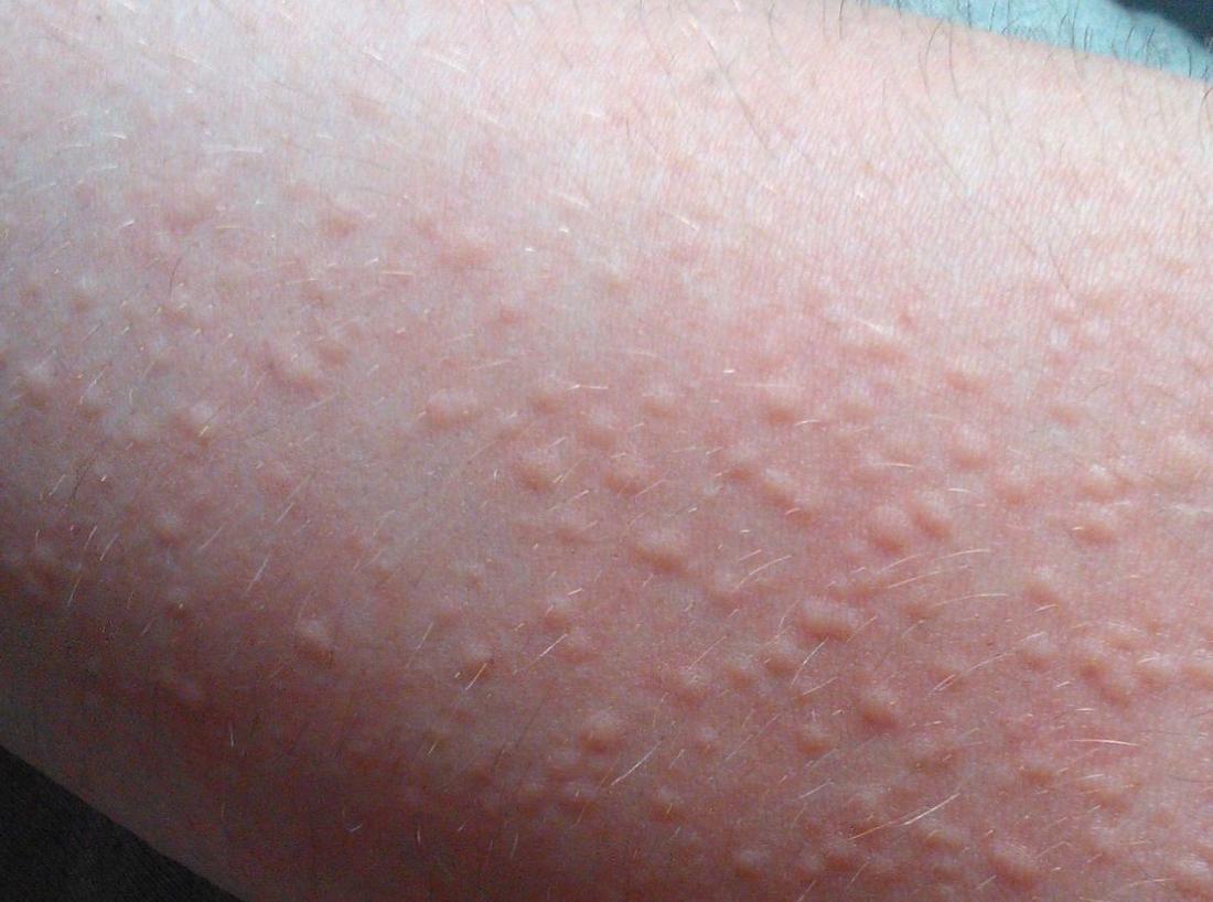 Cholinergic Urticaria, Kondisi Kesehatan yang Diderita Salah Satu Member BTS