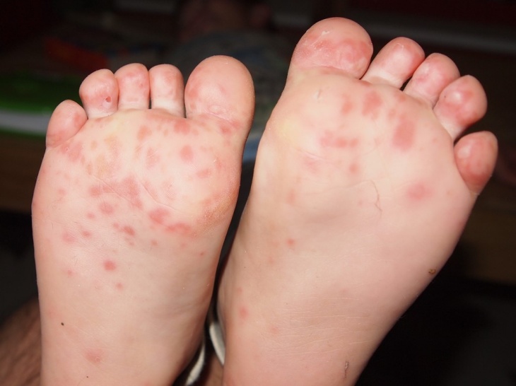 Kenali Gejala Flu Tomat yang Mewabah di India