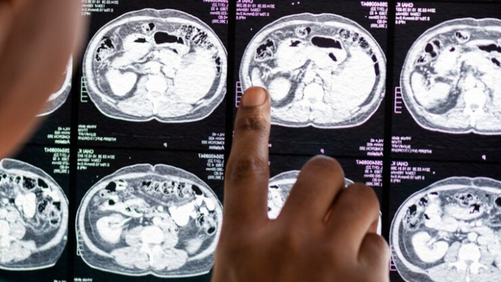 Mengenal Penyebab Pendarahan Otak yang Dialami Indra Bekti