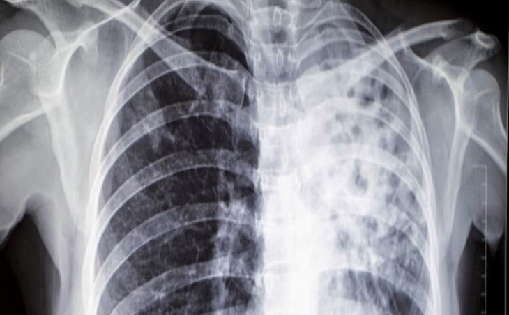 tuberkulosis