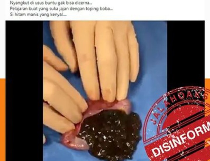 [HOAKS atau FAKTA] Minum Boba Menyebabkan Usus Buntu