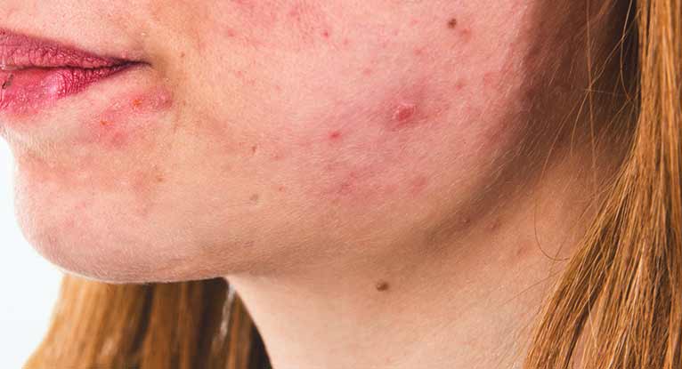 granuloma kerusakan jaringan kulit