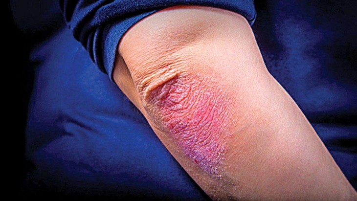 Ini Beberapa Penyebab Timbulnya Penyakit Kulit Psoriasis