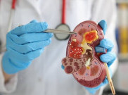 Minim Risiko, Ini Keunggulan Transplantasi Ginjal