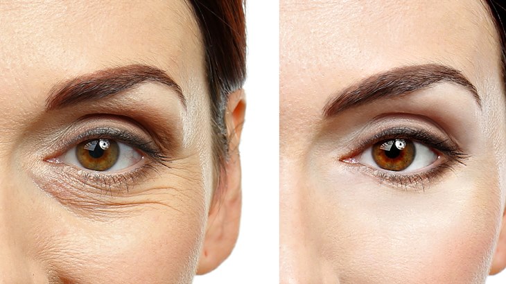 Blepharoplasty Mereparasi Seputar Mata