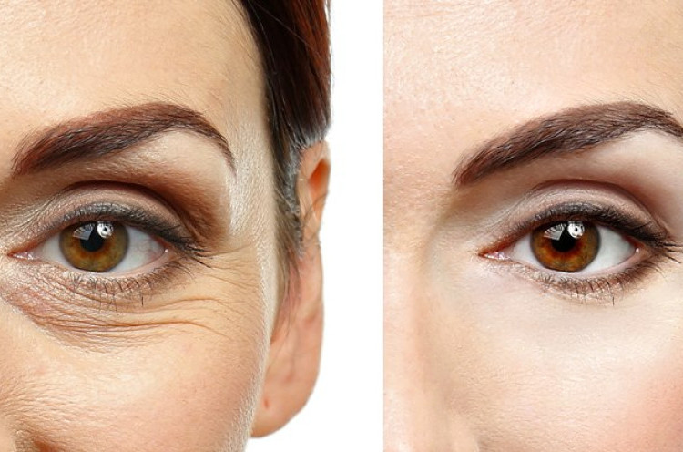 Blepharoplasty Mereparasi Seputar Mata