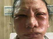 Wajah Ratna Sarumpaet Lebam, Dianiaya di Sekitar Bandara?