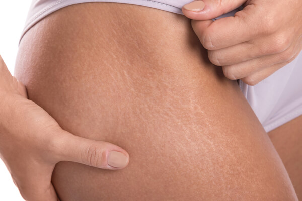 baby oil untuk stretch marks