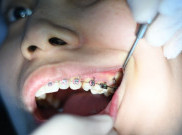 Waktu Terbaik Memasang Behel