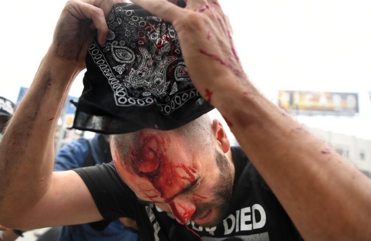 Seorang pendemo terluka parah setelah terkena peluru karet. (Foto: LA Times) 