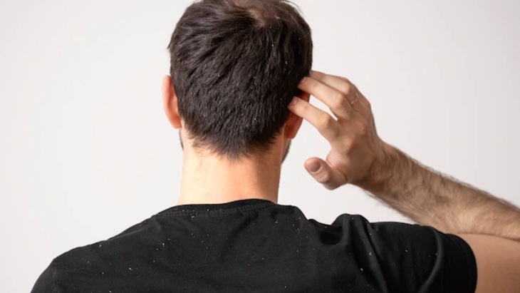 Bahagia Rambut Bersih dari Ketombe