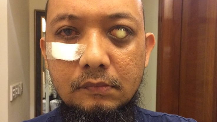 Kabar Baik, Begini Kondisi Terbaru Mata Kanan Novel Baswedan