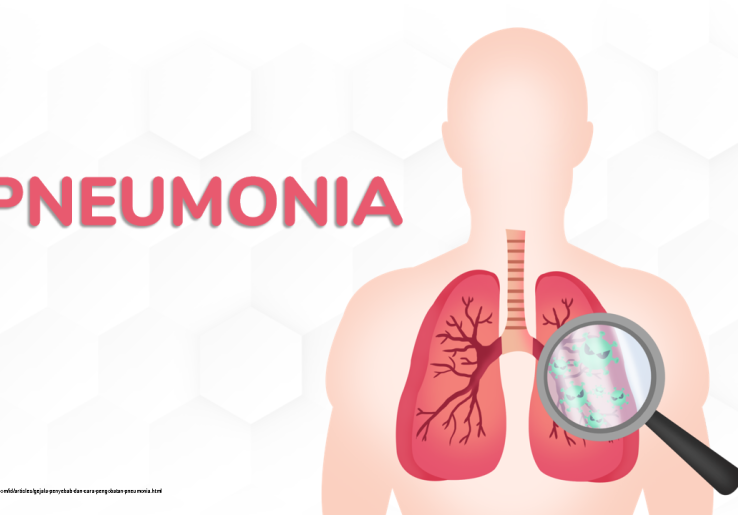 Bahaya Pneumonia Yang Masuk 10 Besar Penyebab Kematian Akibat Penyakit Infeksius di Indonesia