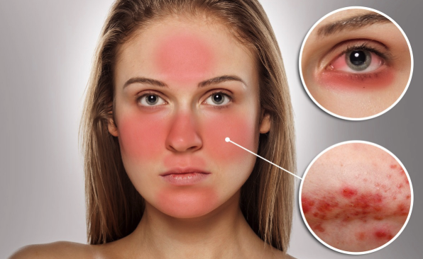 5 Faktor Penyebab Penyakit Rosacea Menurut Ahli Dermatologi