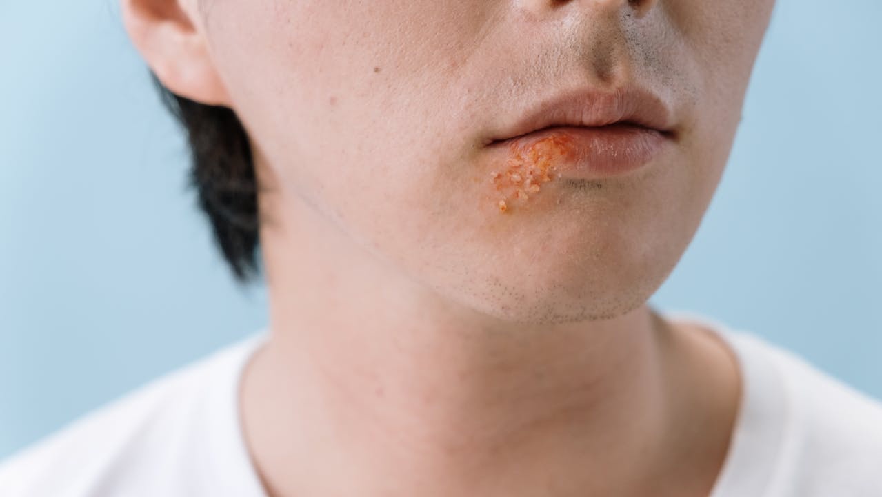 Mengenal Penyakit Herpes dan Penyebab Penularannya