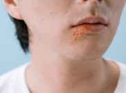 Mengenal Penyakit Herpes dan Penyebab Penularannya
