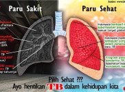 Ini Cara Orang Tua Dulu Mengobati Penyakit TBC