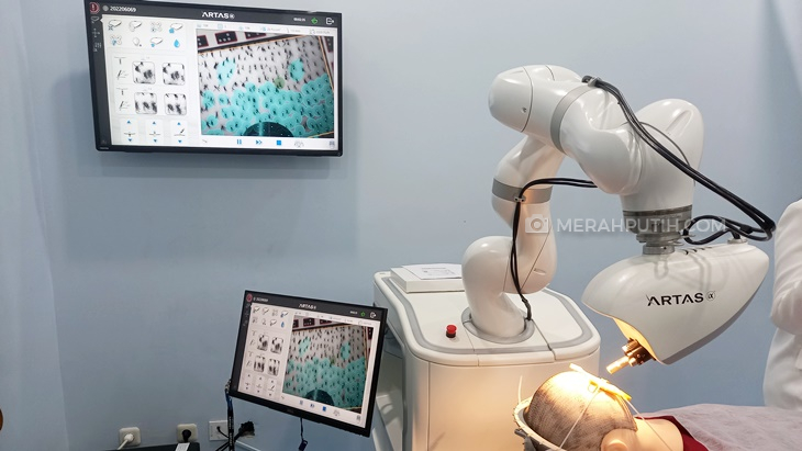 Transplantasi Rambut Robotik dengan Teknologi AI Hadir di Indonesia