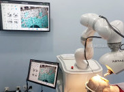 Transplantasi Rambut Robotik dengan Teknologi AI Hadir di Indonesia