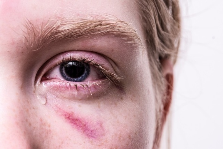 Perilaku Hiperseks Bisa Jadi Tanda PTSD