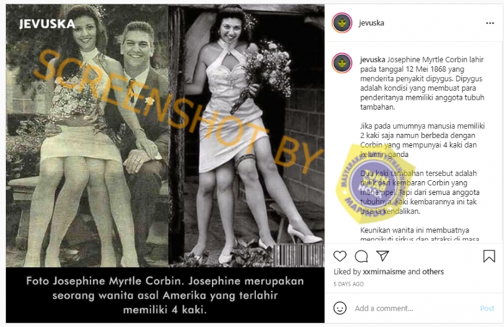 Hoaks soal Josephine Myrtle Corbin, wanita yang miliki empat kaki. (Foto: MP/turnbackhoax.id)