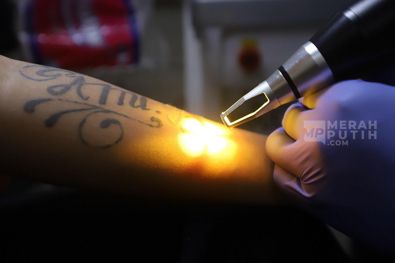 Warga Manfaatkan Layanan Hapus Tato Gratis saat Bulan Suci Ramadan 1446 H di Jakarta