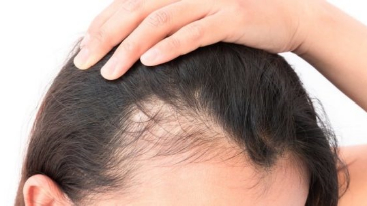 Ternyata Atasi Rambut Rontok Itu Mudah
