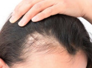 Ternyata Atasi Rambut Rontok Itu Mudah
