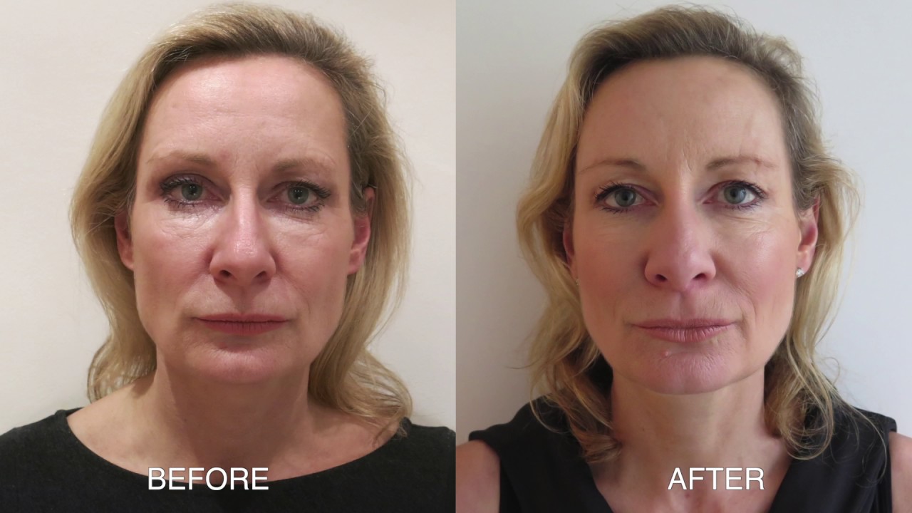 Inilah Perbedaan Sebelum dan Sesudah Menggunakan Thread Lift (foto: the cosmetic skin clinic)