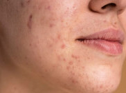 Atasi Jerawat Ala Korean Expert Treatment