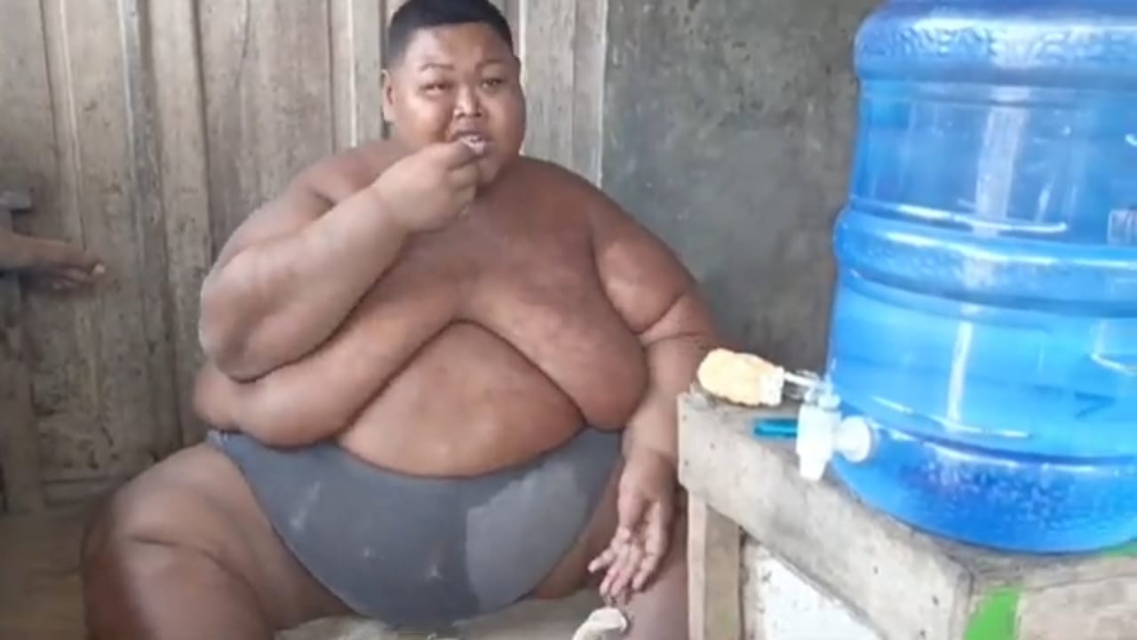 Pemuda Asal Sragen Alami Obesitas 165 Kilogram, Hanya Bisa Rawat Jalan