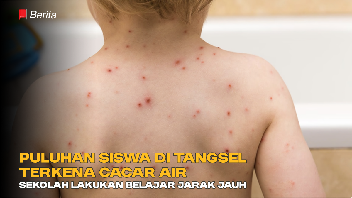 Puluhan Siswa di Tangsel Terkena Cacar Air, Sekolah Lakukan Belajar Jarak Jauh