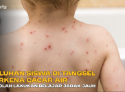 Puluhan Siswa di Tangsel Terkena Cacar Air, Sekolah Lakukan Belajar Jarak Jauh