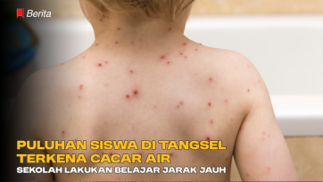 Puluhan Siswa di Tangsel Terkena Cacar Air, Sekolah Lakukan Belajar Jarak Jauh