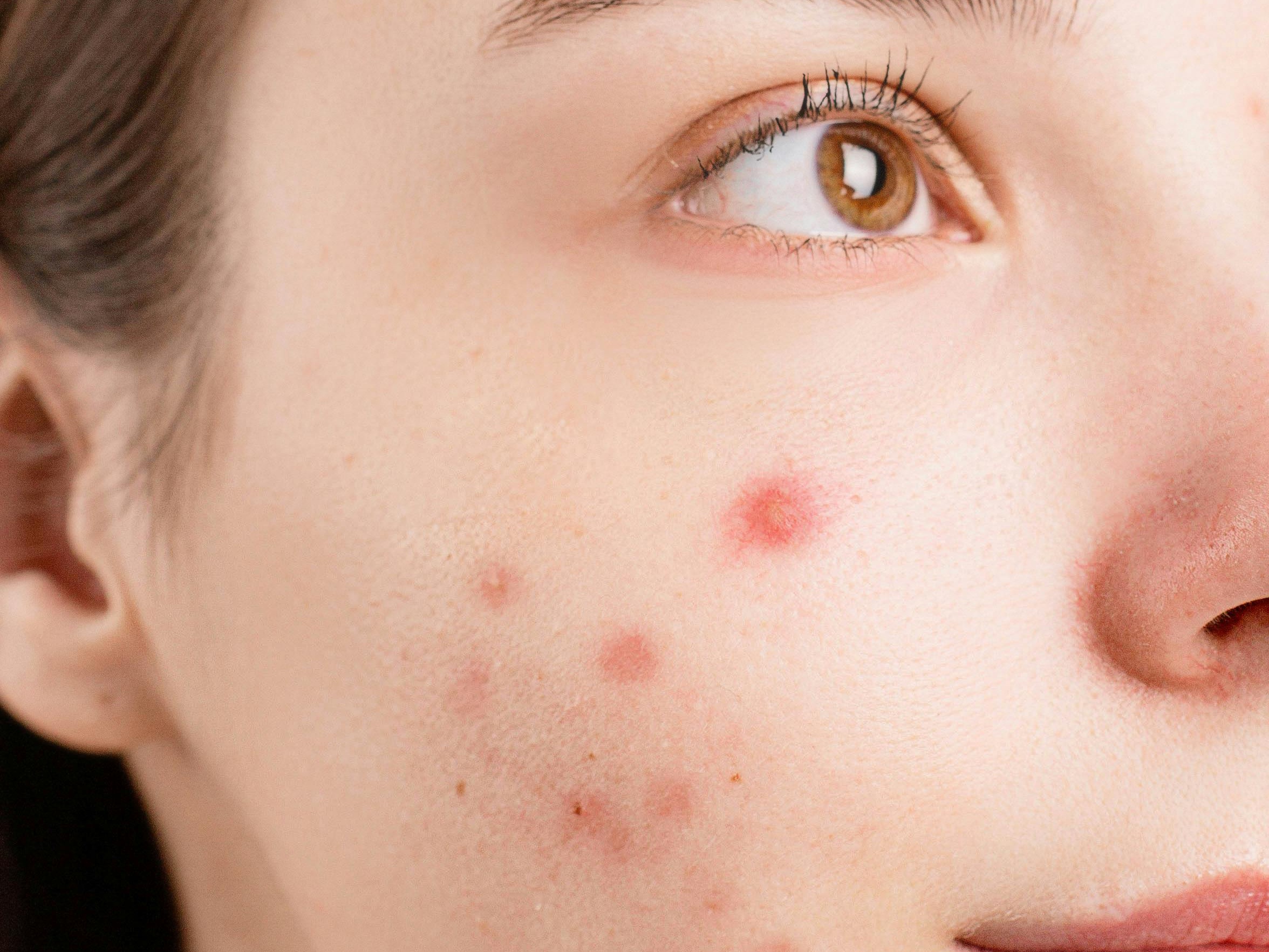 Hilangkan Jerawat Bandel Seminggu sebelum Lebaran, Moisturizer Bahan Aktif Cica dan Panthenol Jawabannya
