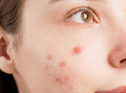 Hilangkan Jerawat Bandel Seminggu sebelum Lebaran, Moisturizer Bahan Aktif Cica dan Panthenol Jawabannya