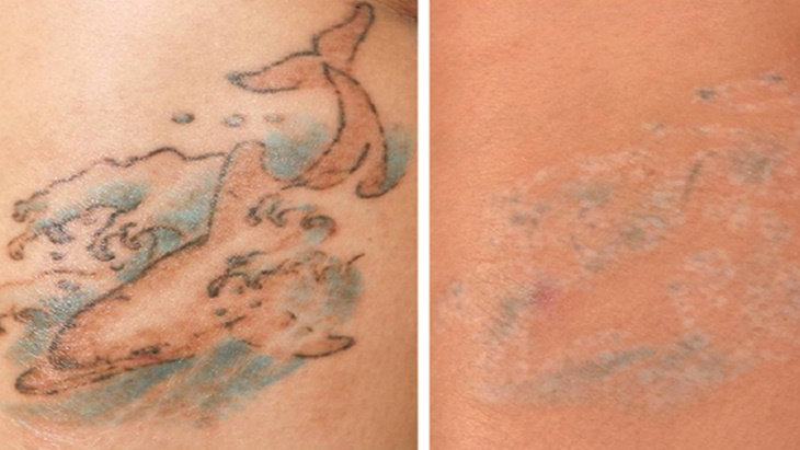 Hilangkan Tato Pakai Laser, Dijamin Aman?
