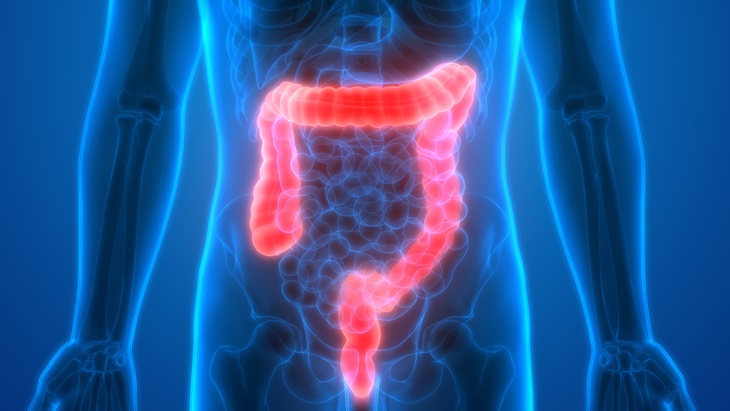 Personalised Medicine bagi Penderita Kanker Kolorektal
