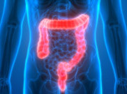 Personalised Medicine bagi Penderita Kanker Kolorektal