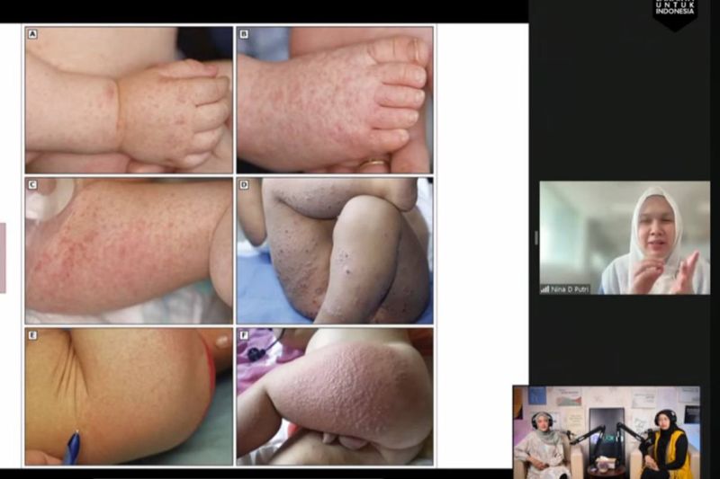 Hai Bunda! Cara Bedakan Flu Singapura, Cacar Air dan Sariawan pada Anak