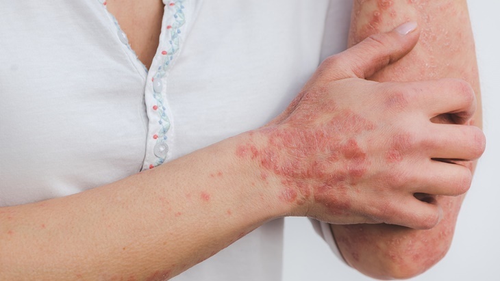  Jangan Anggap Enteng Psoriasis