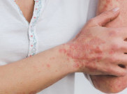 Jangan Anggap Enteng Psoriasis