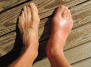 Kontrol Asam Urat dengan 4 Makanan Ini