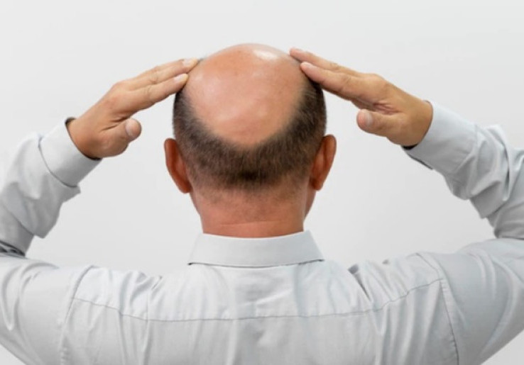 Studi Terbaru Ungkap Solusi untuk Masalah Kebotakan Rambut