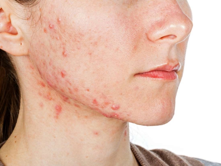 Hindari dermaplaning jika kamu sedang berjerawat. (Foto: medgadget.com)