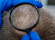 Mikropigmentasi Kulit Kepala Menyamarkan Penipisan Rambut