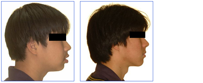 Tampak samping sebelum dan sesudah menggunakan behel. (Foto Lumino Orthodontists Max Beresford)