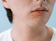 Mengenal Penyakit Herpes, Bagaimana Seseorang Bisa Tertular?