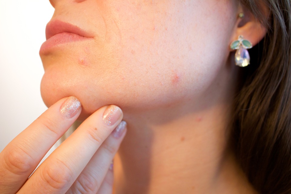 Ada ebebrapa bagian tubuh yang biasa diserang psoriasis (Pixabay/Kjerstin_Michaela)